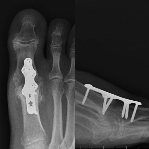 M Tp Normal Rom 1St Mtp Rom Norm : Normal Range of Motion for the Great Toe – JLQSS