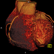 CT Koronarangiographie