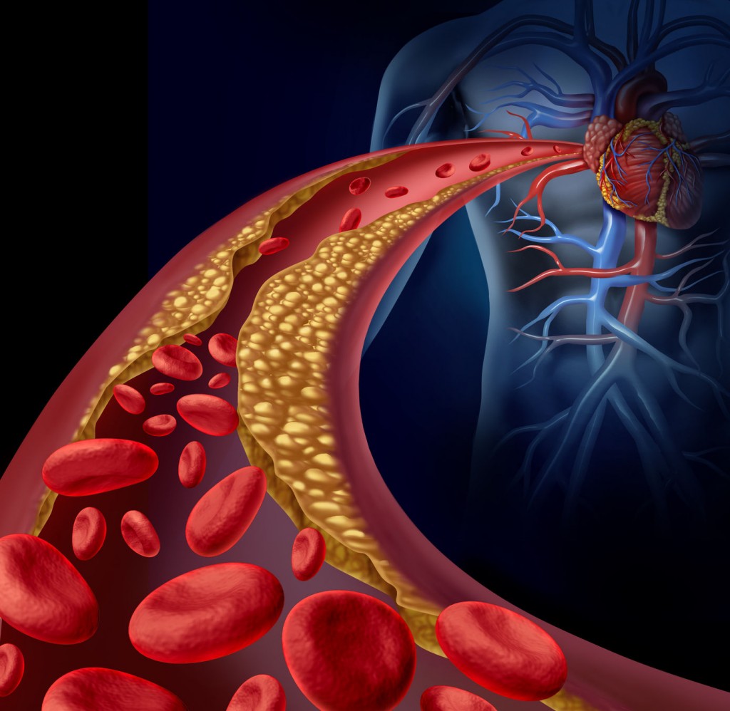 Lipid Disorders