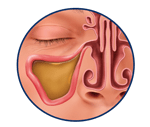 Sinus infection
