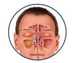Balloon Sinuplasty Procedure