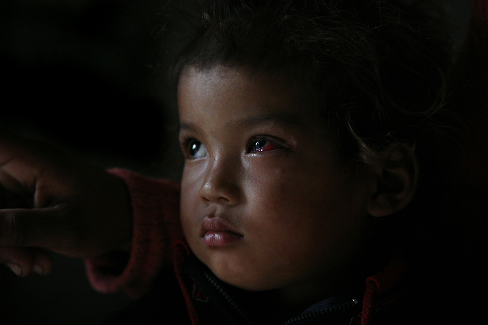 foto van een kind met een beschadigd oog