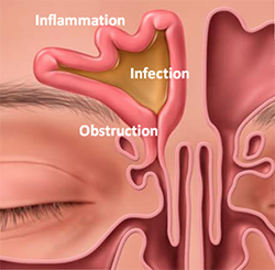 Sinus Infection Problem