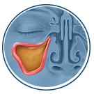 Balloon Sinuplasty - Locate