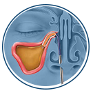 Balloon Sinuplasty - Dilate