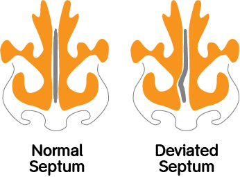 Normal Septum vs Deviated Septum