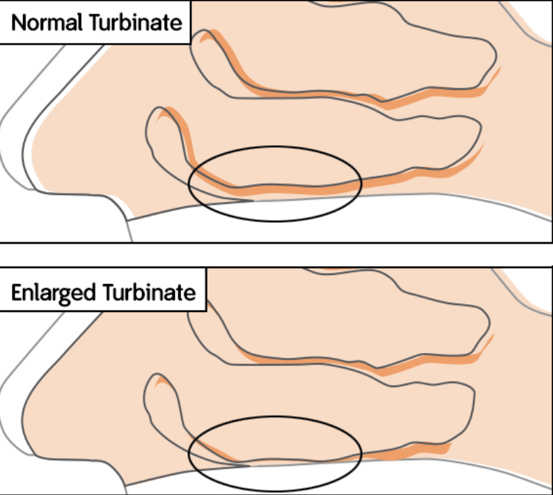 Normal vs Enlarged Turbinate