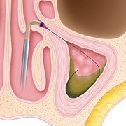 Sinuplasty Procedure Step 1