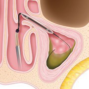Sinuplasty Procedure Step 2