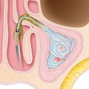 Sinuplasty Procedure Step 3