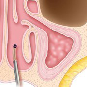 Sinuplasty Procedure Step 4