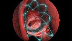 PROPEL Procedure