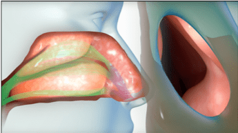 Safe, Effective, Treatment for Nasal Obstruction