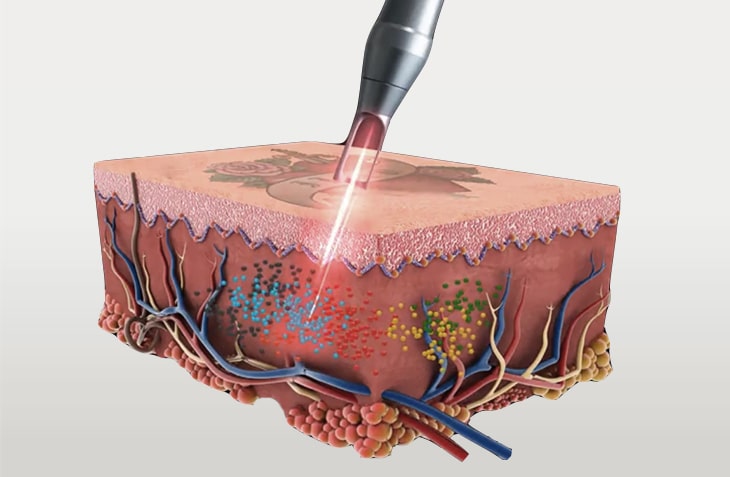 PICOCARE laser tatoo removal