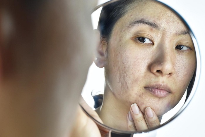 Pico acne laser treatment for acne problem