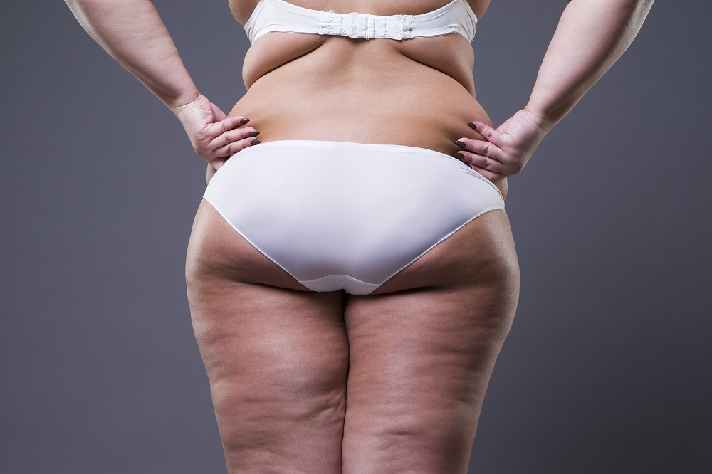 fat transfer