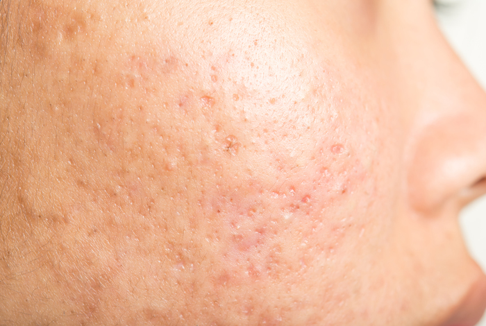 Picocare Fractional Laser 2