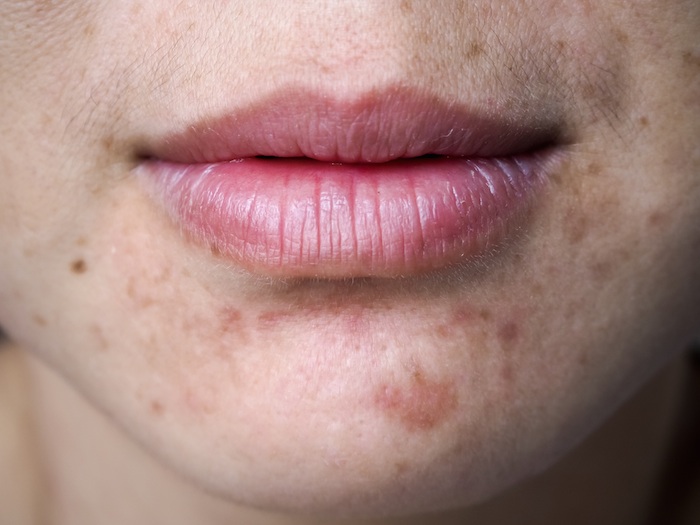 Picocare Fractional Laser 1