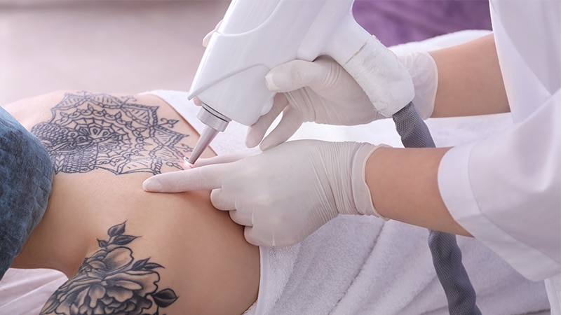 pico laser tattoo removal treatment singapore amaris b clinic