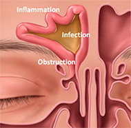 Sinus Infection Diagram