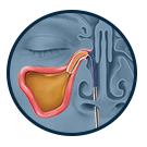 Balloon Sinuplasty Treatment Option