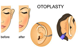Otoplasty Procedure Animation