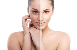 Facial Skin Peel