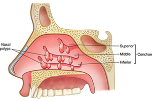 Diagram of Nasal Polyps