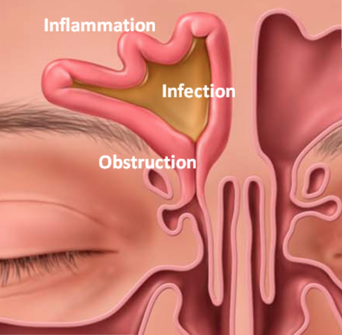 Sinus Infection, Inflammation