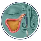Balloon Sinus Procedure