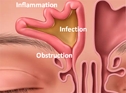 Graphic showing sinus swelling, inflammation and infection.