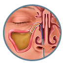 Graphic showing instrumentation to locate the blocked sinus.