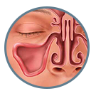 Graphic showing unlcogged sinus passages after The OPEN Procedure.