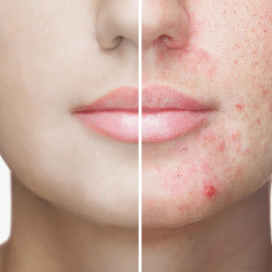 Get Cicatriz De Acne Tratamento Pictures
