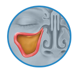 Pain and Inflammation due to Sinus Infection