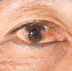 Pterygium present in the eye of a patient