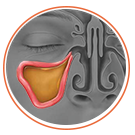 Graphic diagram of sinus inflammation with a blocked passageway