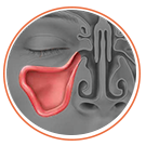 Graphic diagram of an unblocked sinus after a balloon sinuplasty procedure.