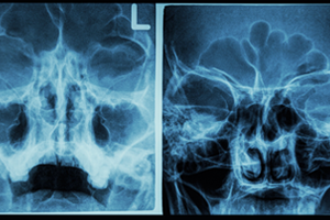 Endoscopic Sinus Surgery-Xrays Help Dr. Brown with Diagnosis