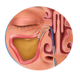 Balloon Sinus Dilation Process - Step 2: Dilation