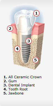 Dental Implants are a Service performed by Dr. Yaron MIller in Vista CA