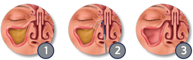 Sinuplasty procedure steps