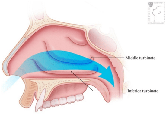 Chronic Nasal Congestion diagram