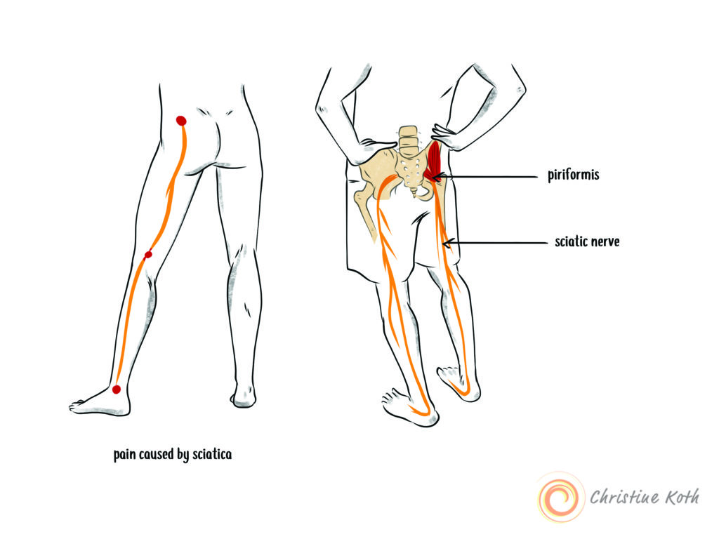 paid caused by sciatica