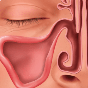Patients experience fast relief with no nasal packing