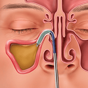 Balloon Sinuplasty Procedure can help provide instant relief