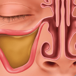 Inflammed, Clogged Sinuses