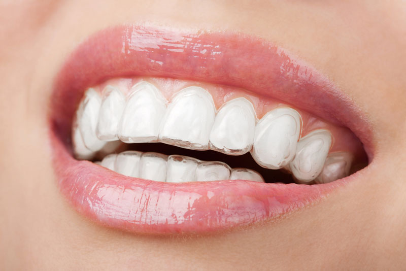 How Much Does Invisalign® Cost