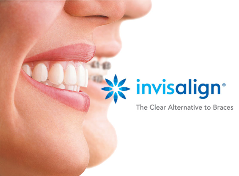 What is Invisalign®