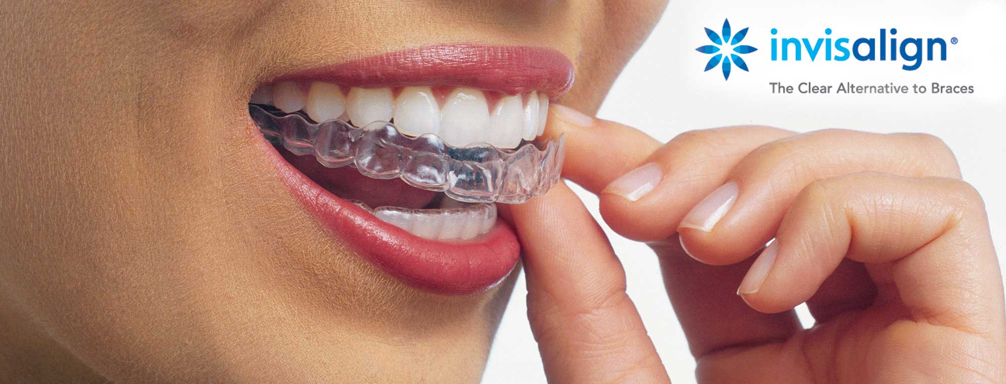 Invisalign® Teen Braces